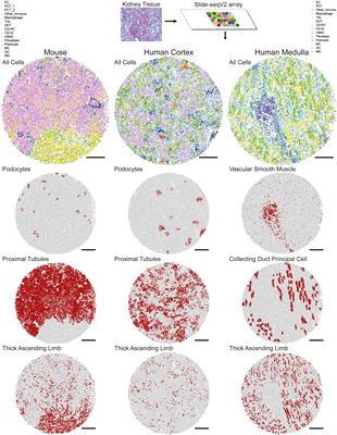 Principles of Spatial Transcriptomics Analysis: A Practical Walk-Through in Kidney Tissue